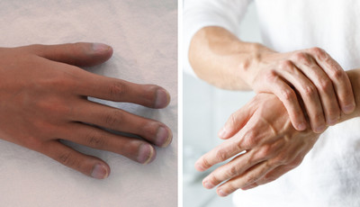 Jak leczyć przytrzaśnięty palec?