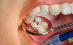 Alarmujące dane: PRÓCHNICA u ponad 40 proc. dzieci w wieku 3 lat i 90 proc. - 18 lat