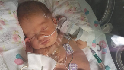 Születése után összeomlott a tüdeje: napokig küzdöttek a koraszülött csecsemő életéért – fotók