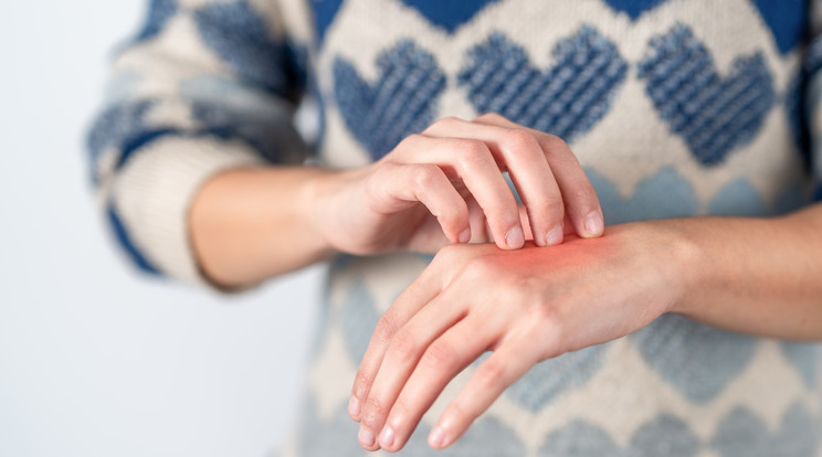 Szokszor viszket és száraz a pajzsmirigy alulműködésben szenvedők bőre/Fotó: Shutterstock