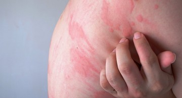 Napallergia: így néznek ki az allergiás tünetek a bőrön