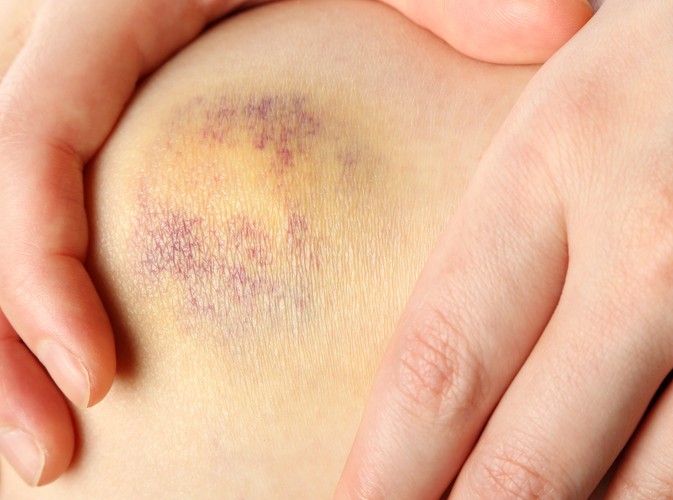 Łatwo pojawiające się siniaki