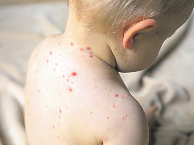 Epidemija malih boginja se stišala