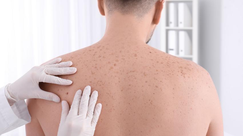 anyajegyszűrés, dermatológus, anyajegy, bőrrák, melanoma