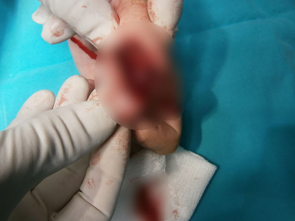 Povreda izazvana petardom