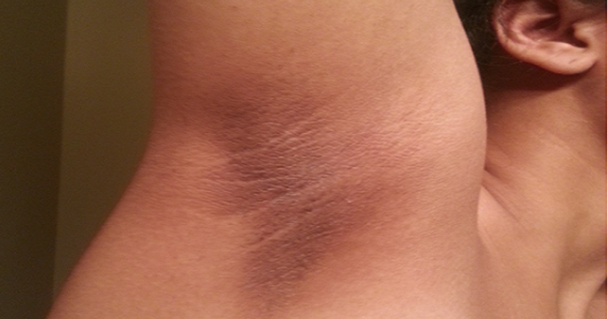 What is this bump under my armpit? I am hoping it isn't anything