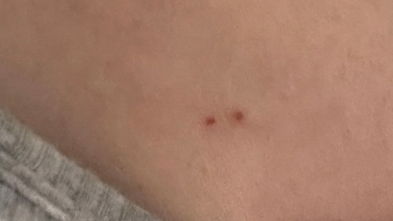 Žena ukázala podivné stopy na koži.