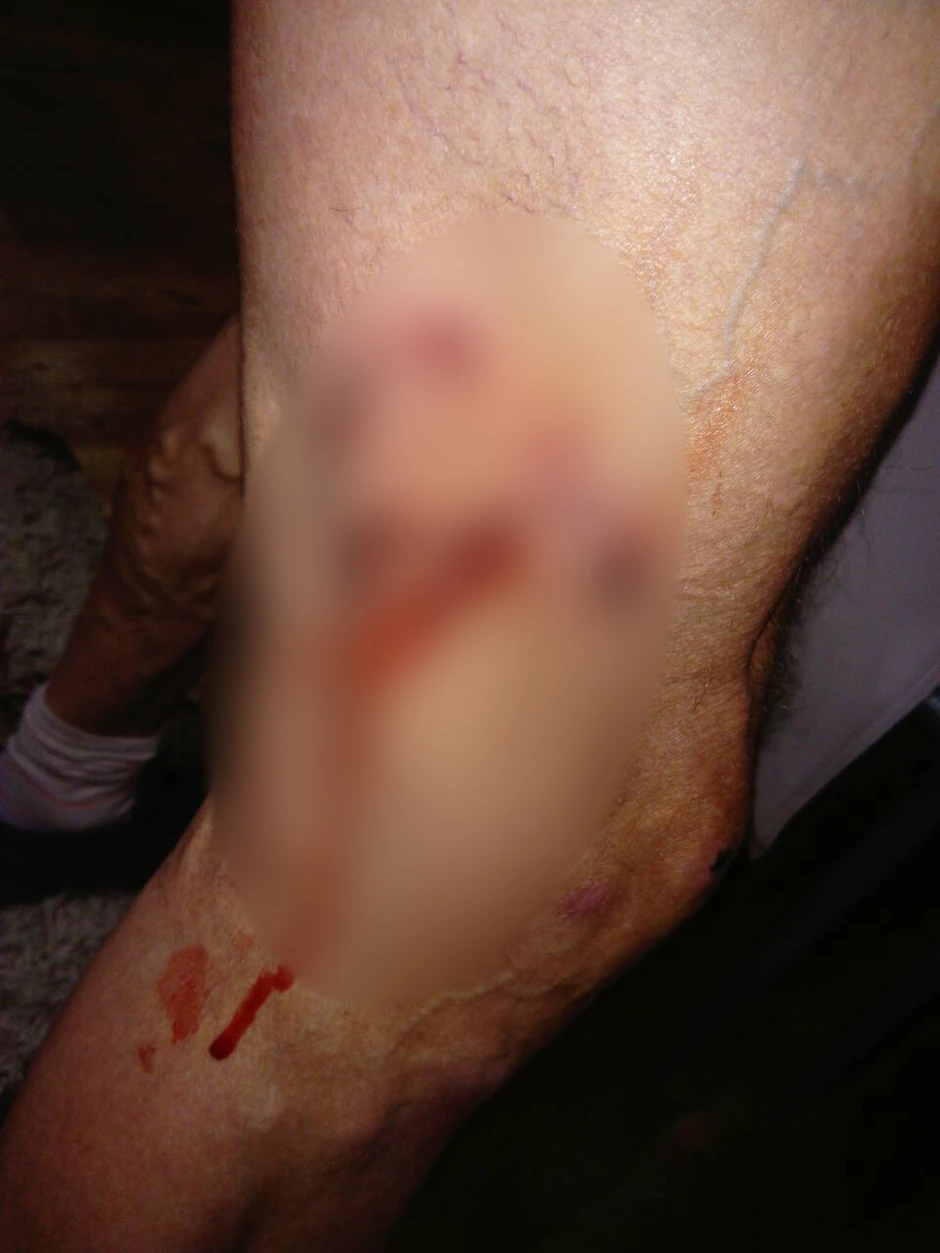 Noga maratonca Ace Krstića posle ujeda pasa lutalica