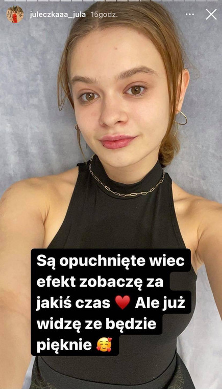 Julia Wróblewska poddała się zabiegowi powiększenia ust