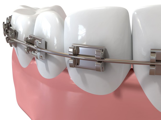 : Czy przed leczeniem ortodontycznym trzeba usunąć zatrzymane ósemki?