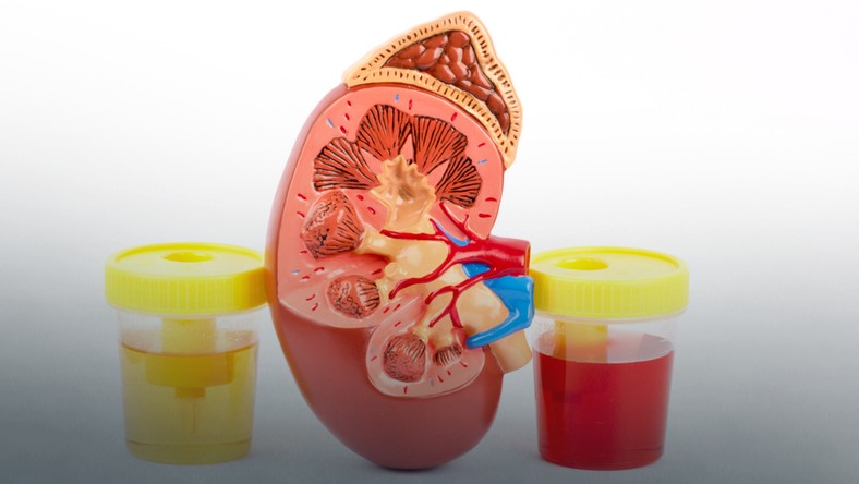 Krwiomocz Jakie Są Przyczyny Co To Oznacza Zdrowie 3325