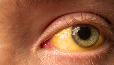 Przekrwione oczy - przyczyny, leczenie