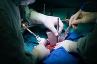 Surgeons transplanting a liver