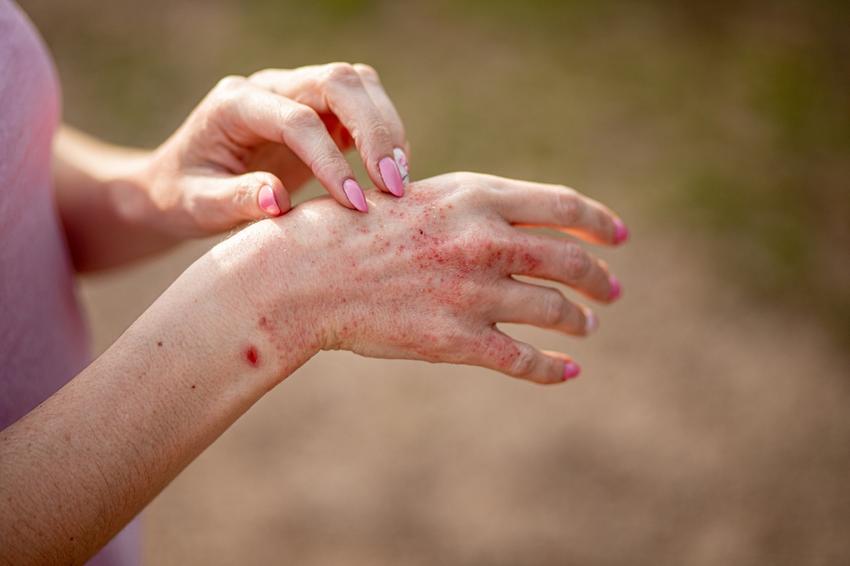Bőrgomba, gombás bőrfertőzés: tünetei, okai és kezelési lehetőségei |  EgészségKalauz