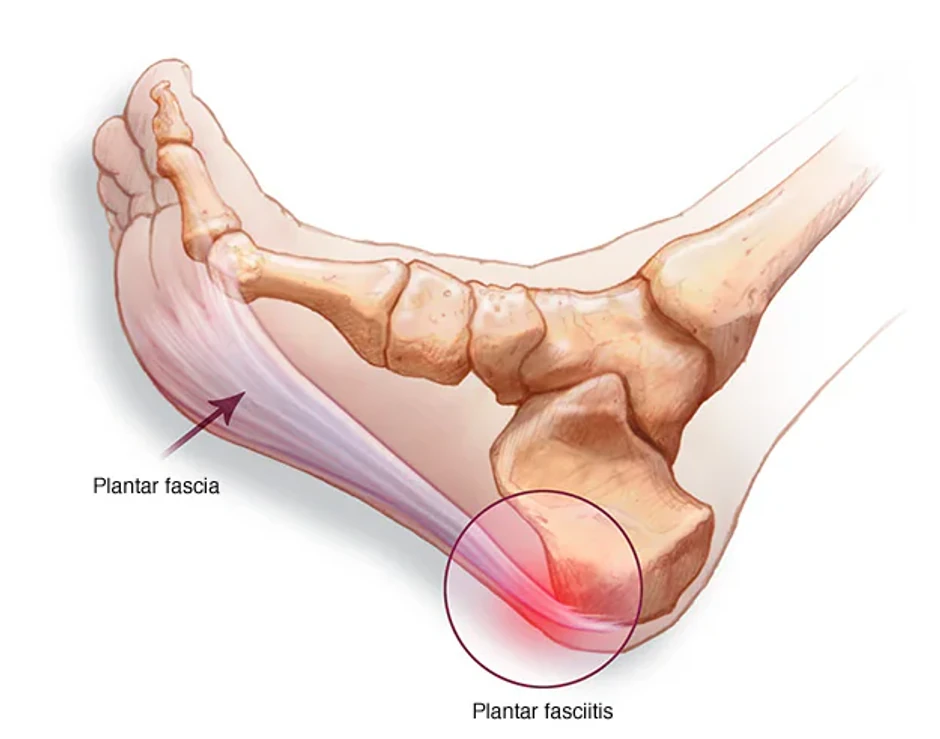 Plantarna fascija je vlaknasta traka koja se proteže od pete do prednjeg dela stopala i prstiju