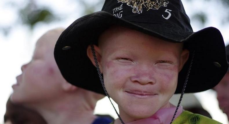 An albino girl smiles in Mitindo Primary School in Nyawilimilwa, Mwanza region of Tanzania, in a file photo. REUTERS/Katrina Manson