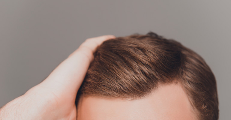 Jak zatrzymać proces utraty włosów?  Najczęstsze przyczyny łysienia