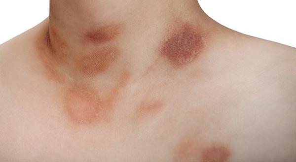 Piros kiütések a bőrön? 6 gyakori betegség, ami okozhatja