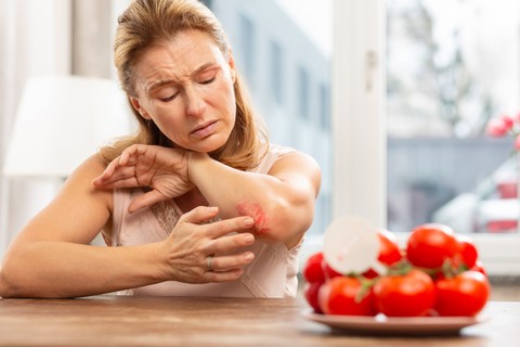 Ételallergia és allergiás kiütések: ezt üzeni a bőr az immunrendszerünkről