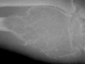 osteoclastoma-d00000ABE07993d3179b0