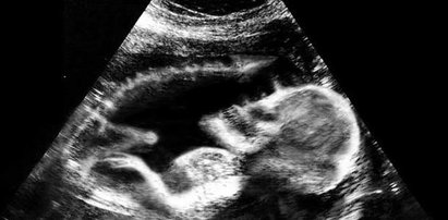 Demoniczne zdjęcia USG. Matki bały się porodu