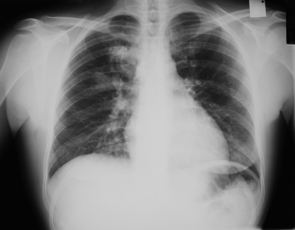 Chudnutie pomocou röntgenového žiarenia.