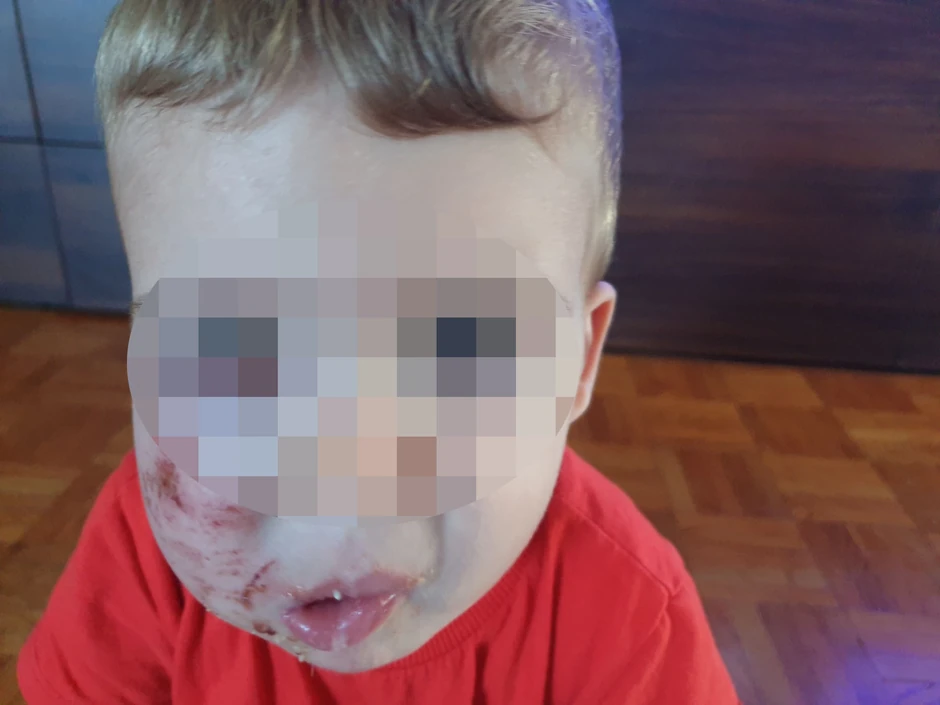 Mali Itan sa ogrebotinama i podlivima na licu