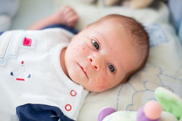 Ezek a csecsemőkori ekcéma, akné, koszmó és milia tünetei