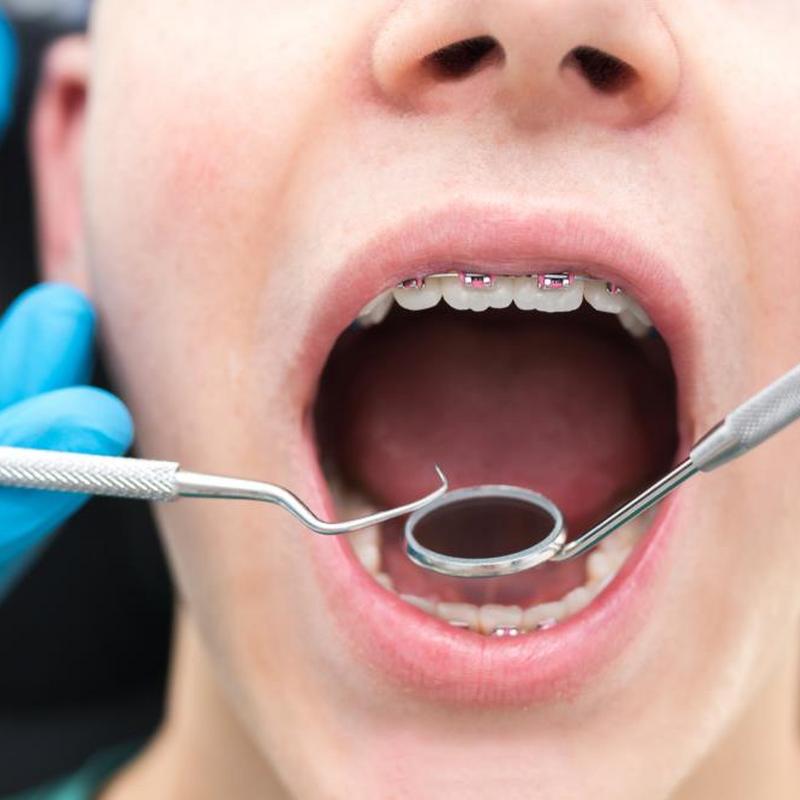 Wybielanie zębów a aparat ortodontyczny. Kiedy najlepiej rozjaśnić zęby?