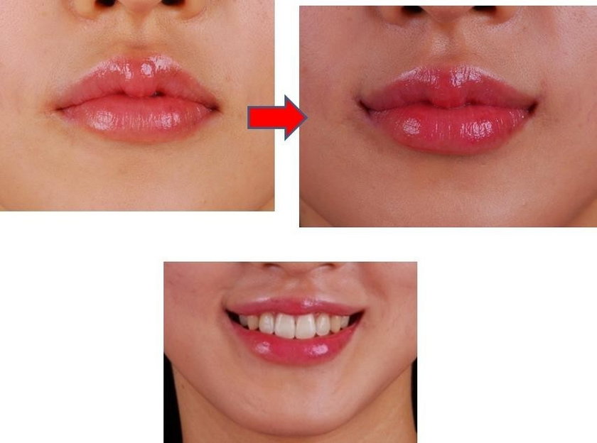 Zabieg podnoszenia kącików ust