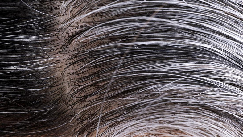Premature Gray Hair: Here is how to reverse this condition naturally