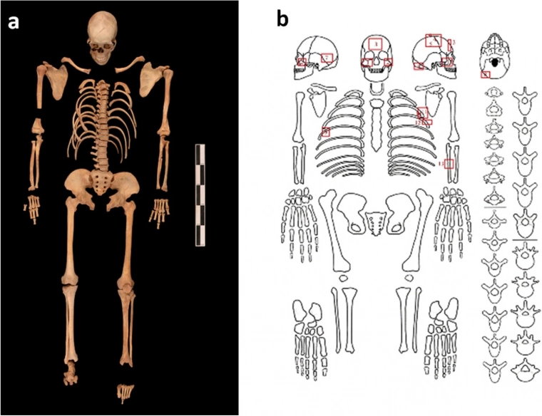 Usytuowanie obrażeń na kościach ofiary / (fot. Wang i in., Archaeological and Anthropological Sciences, 2021)