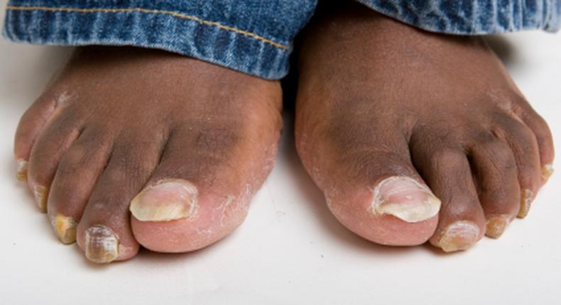 4 home remedies to treating toenail fungus