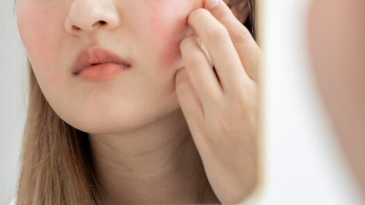 rosacea piros arc, orr, kezelés