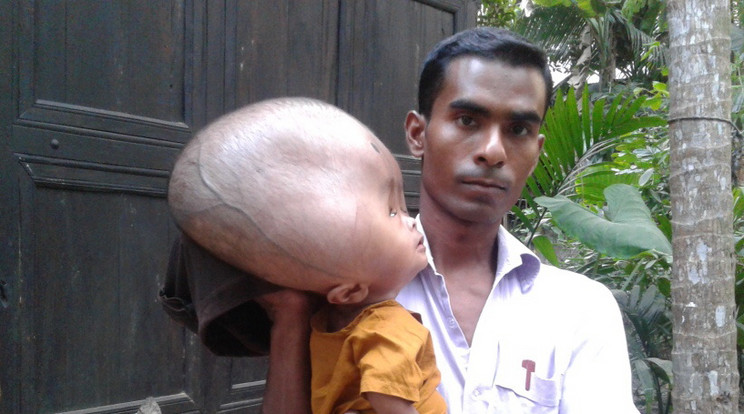 Ennek a kisfiúnak Bangladeshben 9 kg a feje, ami képtelenné teszi bármire / Fotó: PROFIMEDIA-REDDOT