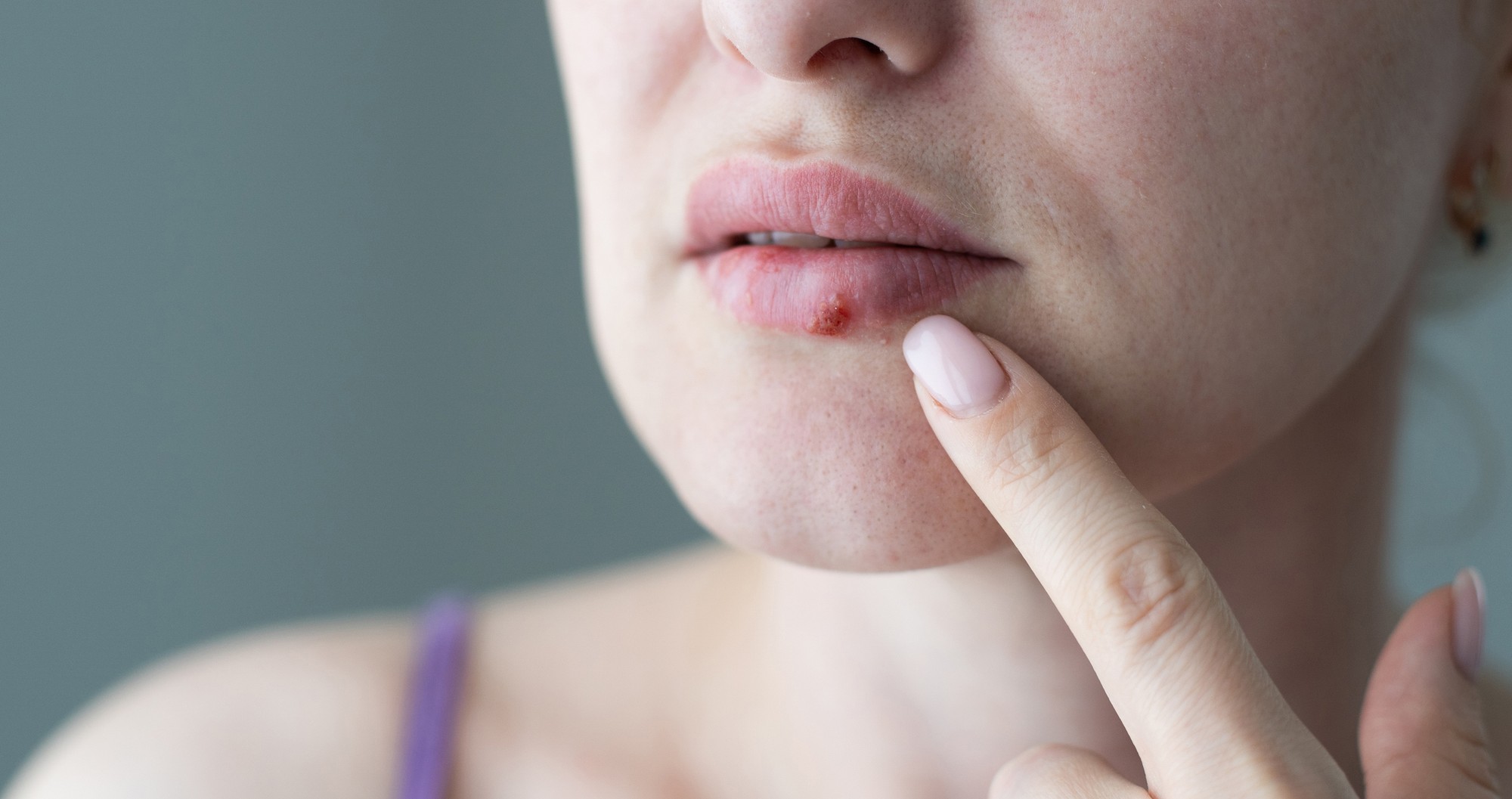 Vedci upravili herpes tak, aby nespôsoboval opary. (ilustračné foto)