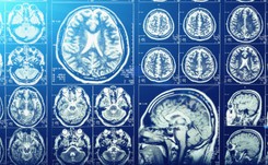 Z chorobami mózgu zmaga się coraz więcej ludzi. Winne NIE TYLKO starzenie się społeczeństw