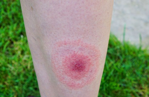 Hogy néz ki a Lyme-folt? Mikor jelenik meg, és vajon mindig látható?