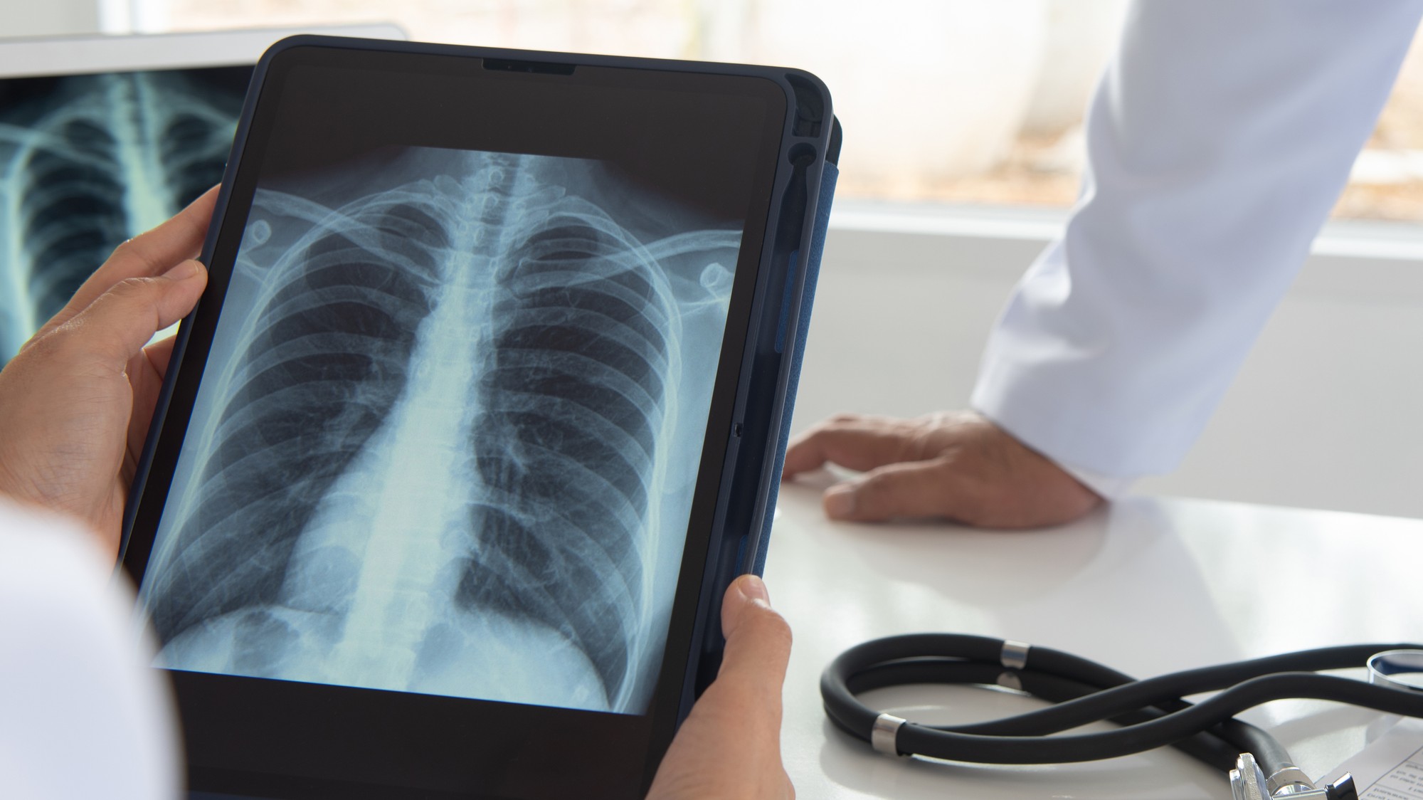 Rakovina pľúc postihuje nielen fajčiarov. (ilustračné foto)