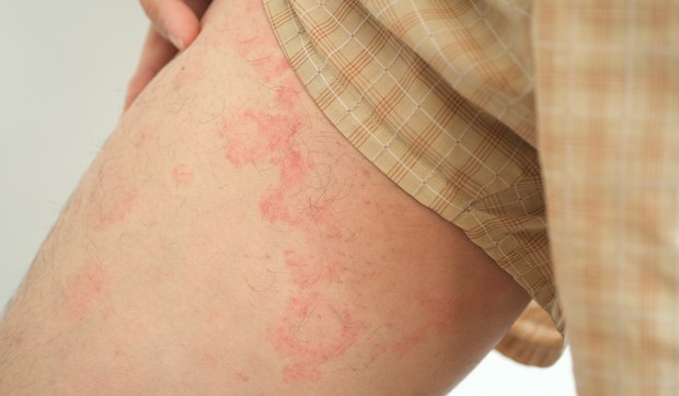 Osip na unutrašnjoj strani butina