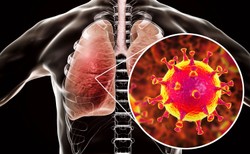 Lekarz: Skany płuc młodych ludzi z koronawirusem są przerażające