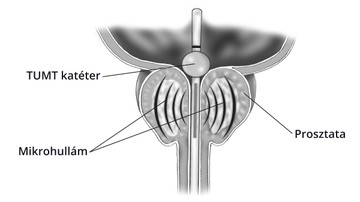 prosztata tippek a kezeléshez)