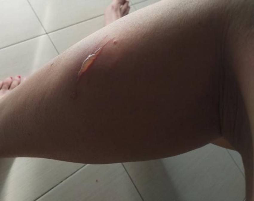 Ostao joj je ožiljak na nozi posle dodira "biljke ubice"