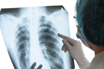 Czy można się ubezpieczyć na wypadek poważnej choroby płuc?