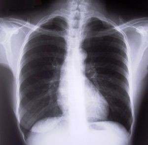 chest-xray-d000000601a3fd155e52b