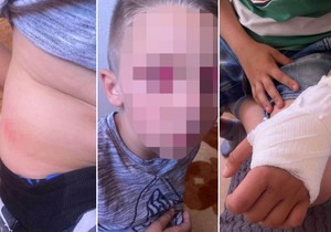 Dečak povređen u Šapcu