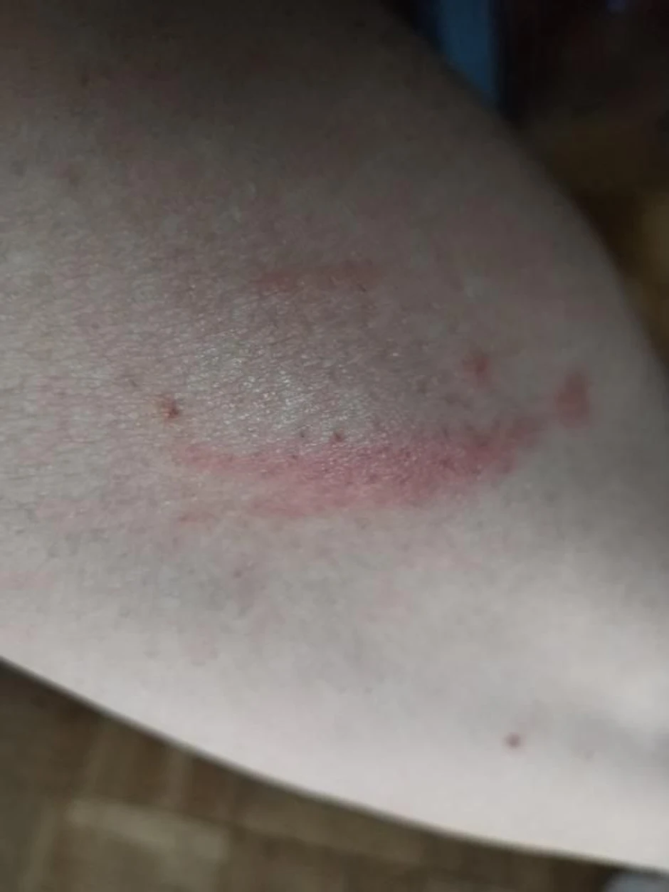 Lozničanka nakon što je dodirnula "biljku ubicu"