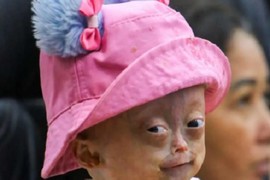 Umrla mala Elis Lima Karnerio (5): Bolovala od retke bolesti koja uzrokuje prerano starenje