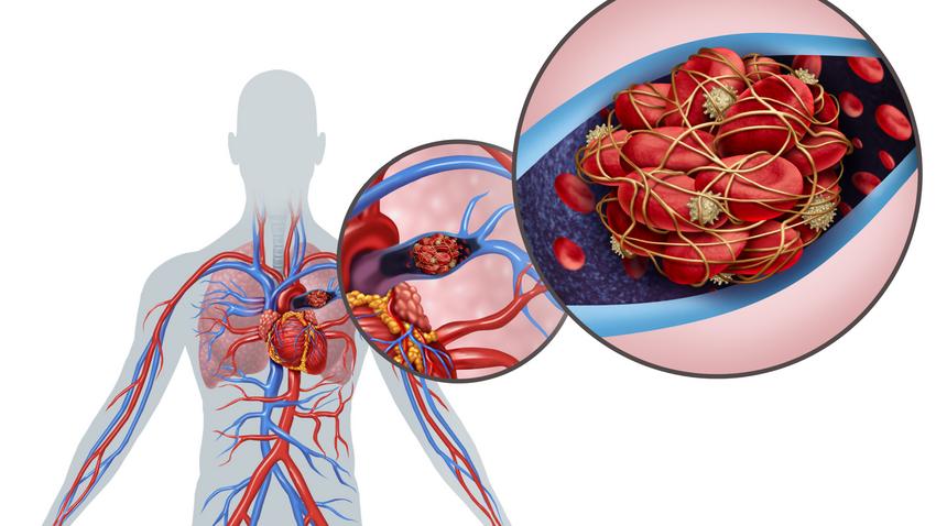 néma trombózis embólia jele vérrög tünete mellkasi fájdalom
