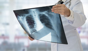  2,5 mln osób rocznie umiera na zapalenie płuc. Choroba najbardziej zagraża trzem grupom osób 